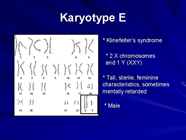 Karyotype E * Klinefelter’s syndrome * 2 X chromosomes and 1 Y (XXY) *