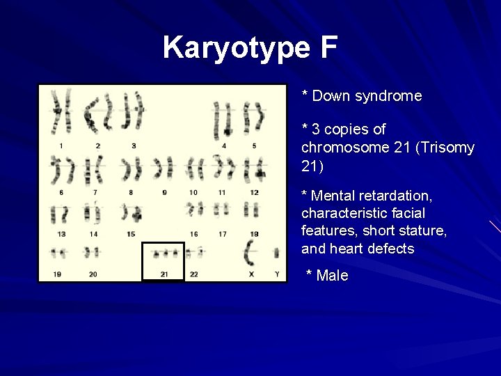 Karyotype F * Down syndrome * 3 copies of chromosome 21 (Trisomy 21) *