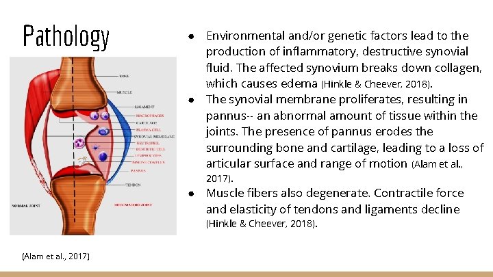 Pathology ● Environmental and/or genetic factors lead to the production of inflammatory, destructive synovial