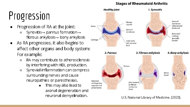 Progression ● Progression of RA at the joint: ○ ● Synovitis→ pannus formation→ fibrous