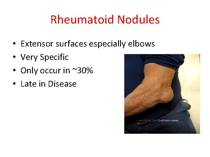 Rheumatoid Nodules • • Extensor surfaces especially elbows Very Specific Only occur in ~30%