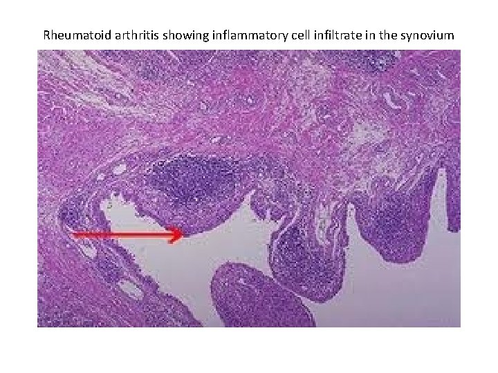 Rheumatoid arthritis showing inflammatory cell infiltrate in the synovium 