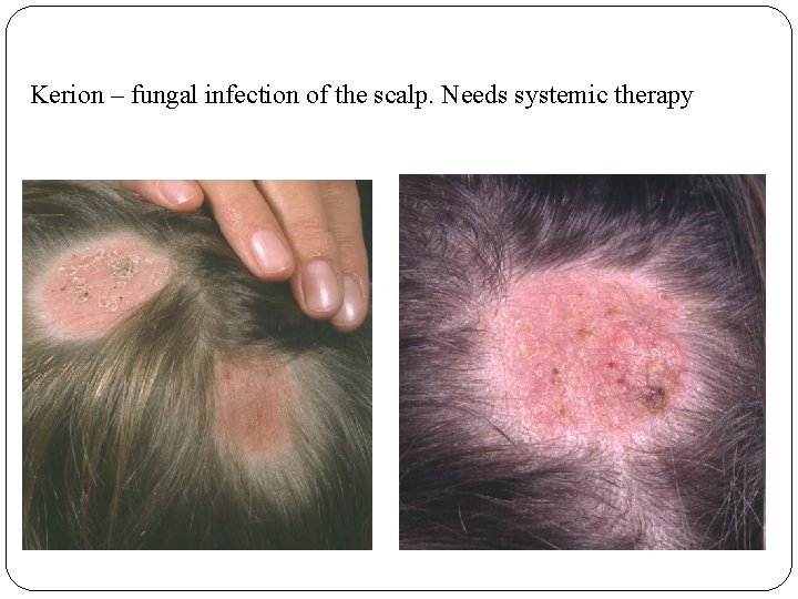Kerion – fungal infection of the scalp. Needs systemic therapy 