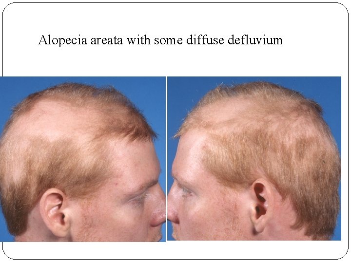 Alopecia areata with some diffuse defluvium 