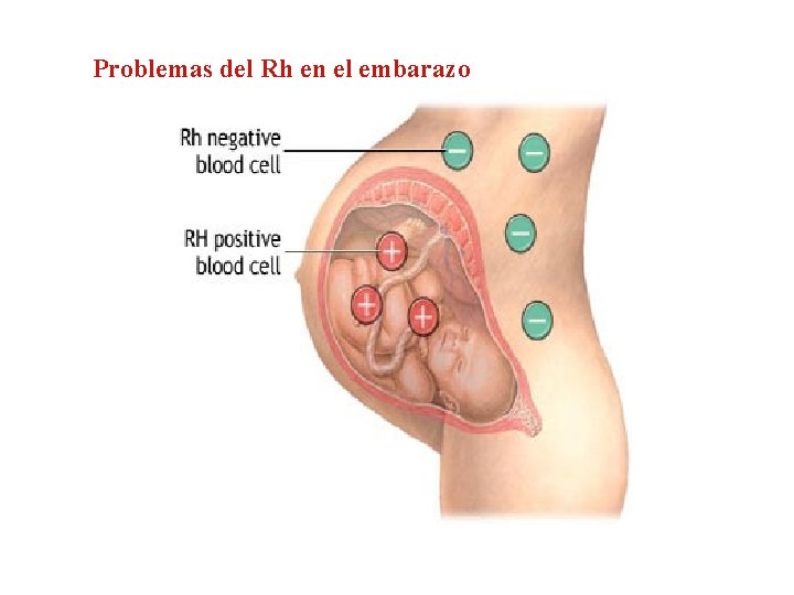 Problemas del Rh en el embarazo 