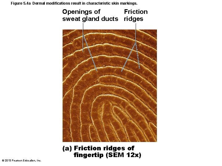 Figure 5. 4 a Dermal modifications result in characteristic skin markings. Openings of Friction Figure 5. 4 a Dermal modifications result in characteristic skin markings. Openings of Friction