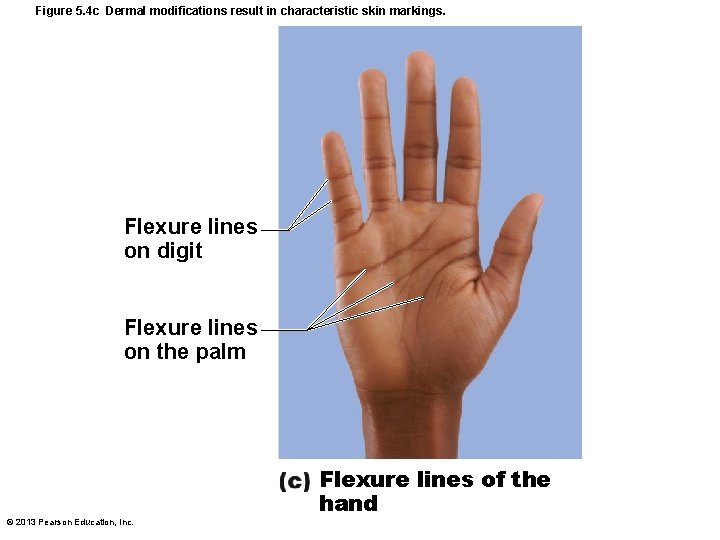 Figure 5. 4 c Dermal modifications result in characteristic skin markings. Flexure lines on Figure 5. 4 c Dermal modifications result in characteristic skin markings. Flexure lines on