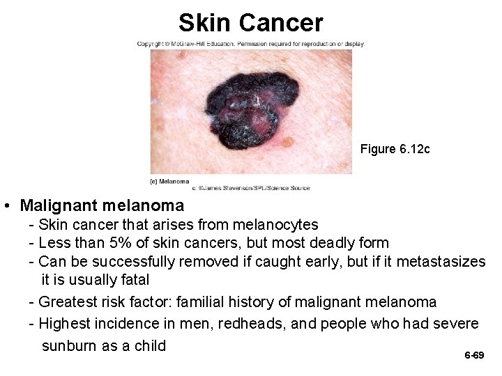 Skin Cancer Figure 6. 12 c • Malignant melanoma - Skin cancer that arises Skin Cancer Figure 6. 12 c • Malignant melanoma - Skin cancer that arises