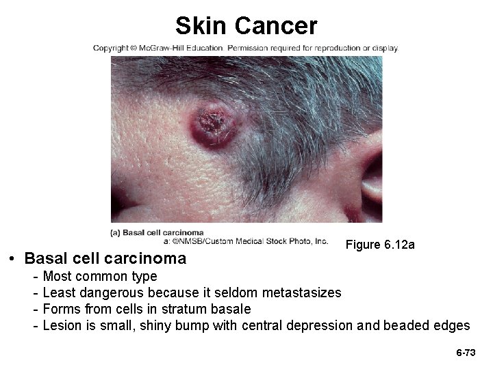 Skin Cancer • Basal cell carcinoma Figure 6. 12 a - Most common type Skin Cancer • Basal cell carcinoma Figure 6. 12 a - Most common type