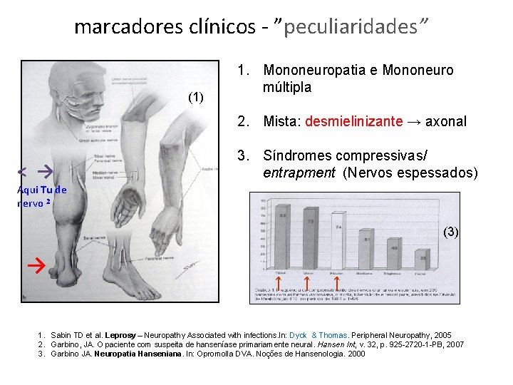 marcadores clínicos - ”peculiaridades” (1) 1. Mononeuropatia e Mononeuro múltipla 2. Mista: desmielinizante →
