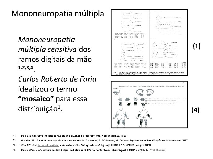Mononeuropatia múltipla sensitiva dos ramos digitais da mão 1, 2, 3, 4. Carlos Roberto