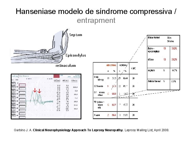 Hanseniase modelo de síndrome compressiva / entrapment Septum Epicondylus retinaculum ↓↓ Garbino J. A.