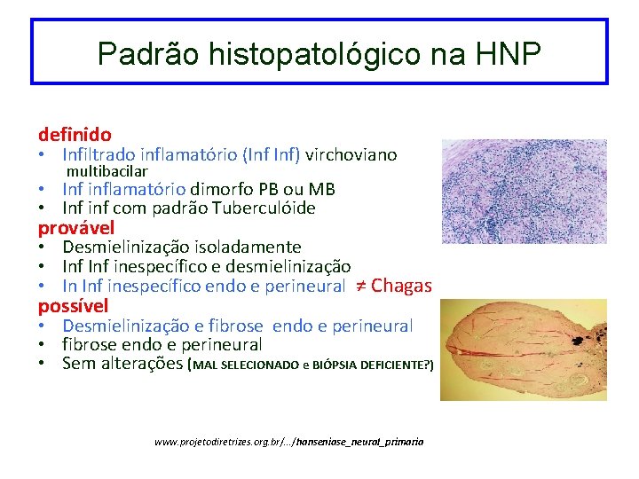 Padrão histopatológico na HNP definido • Infiltrado inflamatório (Inf Inf) virchoviano multibacilar • Inf