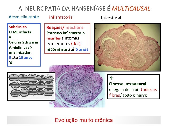 A NEUROPATIA DA HANSENÍASE É MULTICAUSAL: desmielinizante Subclínico O ML infecta a Células Schwann