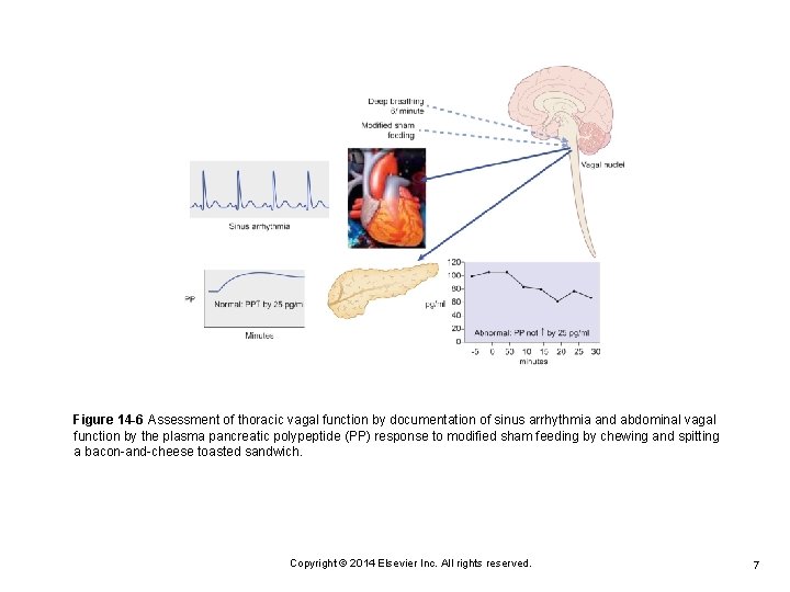 Figure 14 -6 Assessment of thoracic vagal function by documentation of sinus arrhythmia and