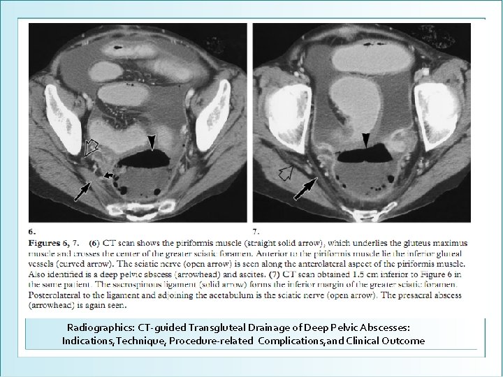 Radiographics: CT-guided Transgluteal Drainage of Deep Pelvic Abscesses: Indications, Technique, Procedure-related Complications, and Clinical
