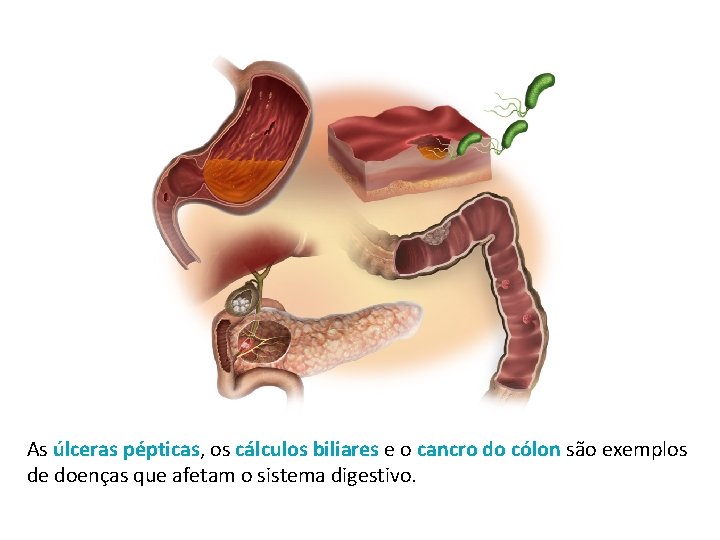As úlceras pépticas, os cálculos biliares e o cancro do cólon são exemplos de