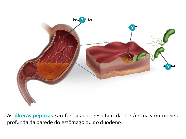 Suco gástrico ? Úlcera ? Bactérias ? As úlceras pépticas são feridas que resultam