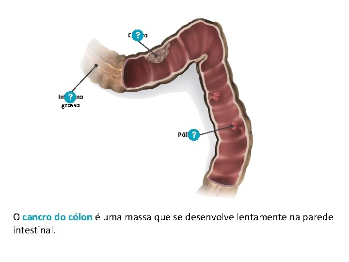 Cancro ? Intestino ? grosso Pólipo ? O cancro do cólon é uma massa