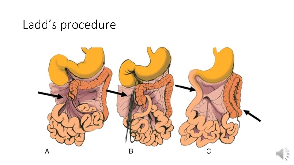 Ladd’s procedure 