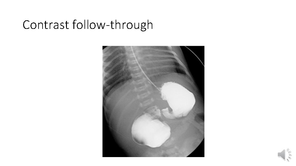 Contrast follow-through 