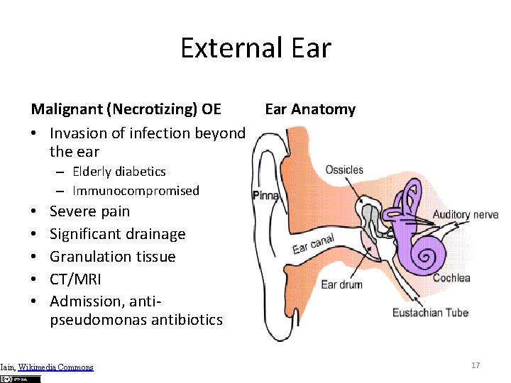 External Ear Malignant (Necrotizing) OE • Invasion of infection beyond the ear Ear Anatomy