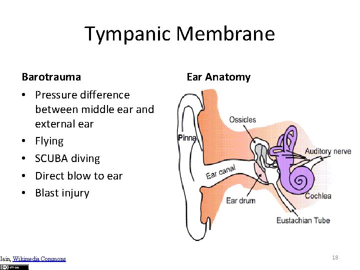 Tympanic Membrane Barotrauma Ear Anatomy • Pressure difference between middle ear and external ear