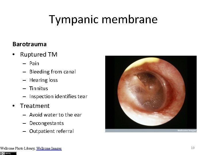 Tympanic membrane Barotrauma • Ruptured TM – – – Pain Bleeding from canal Hearing