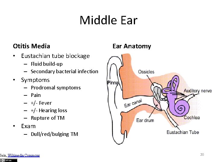 Middle Ear Otitis Media Ear Anatomy • Eustachian tube blockage – Fluid build-up –