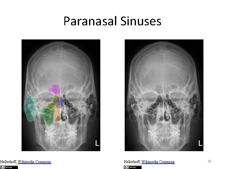 Paranasal Sinuses Hellerhoff, Wikimedia Commons 26 