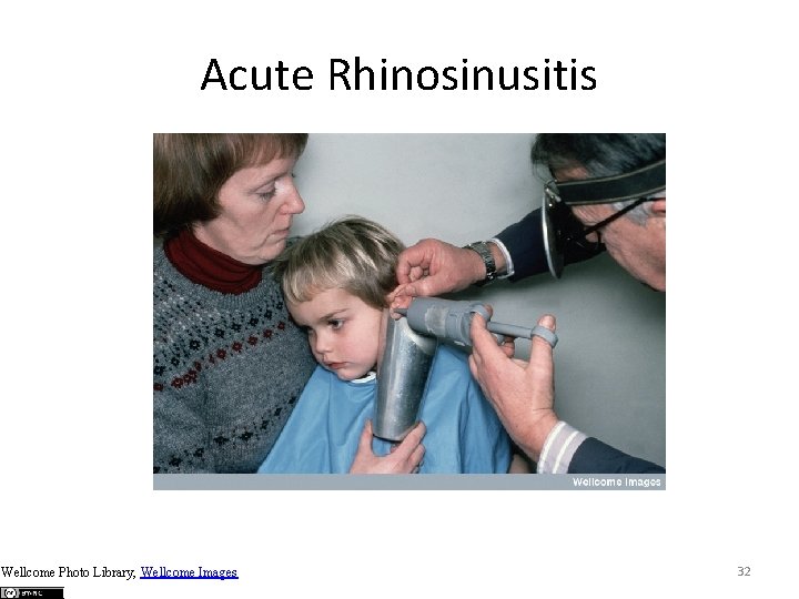 Acute Rhinosinusitis Wellcome Photo Library, Wellcome Images 32 