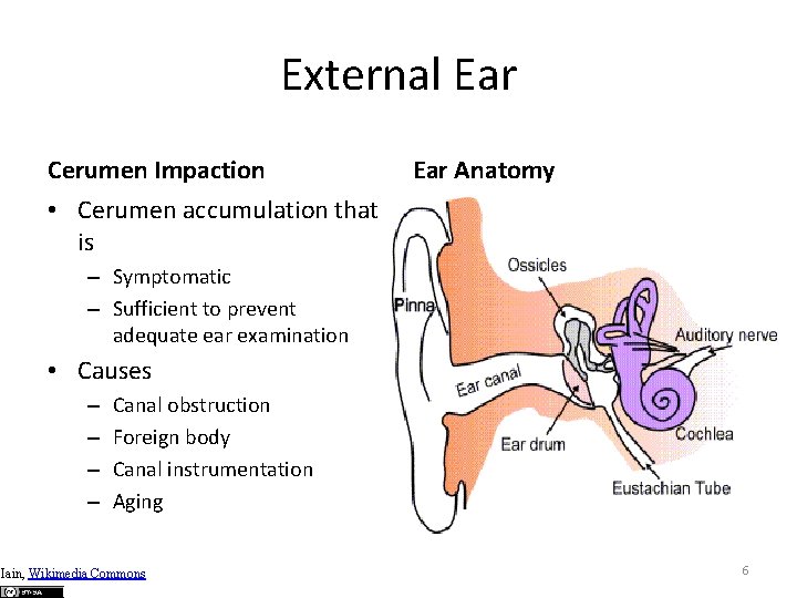 External Ear Cerumen Impaction Ear Anatomy • Cerumen accumulation that is – Symptomatic –