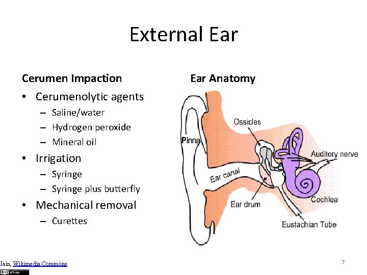 External Ear Cerumen Impaction Ear Anatomy • Cerumenolytic agents – Saline/water – Hydrogen peroxide