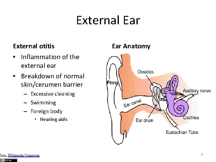 External Ear External otitis Ear Anatomy • Inflammation of the external ear • Breakdown