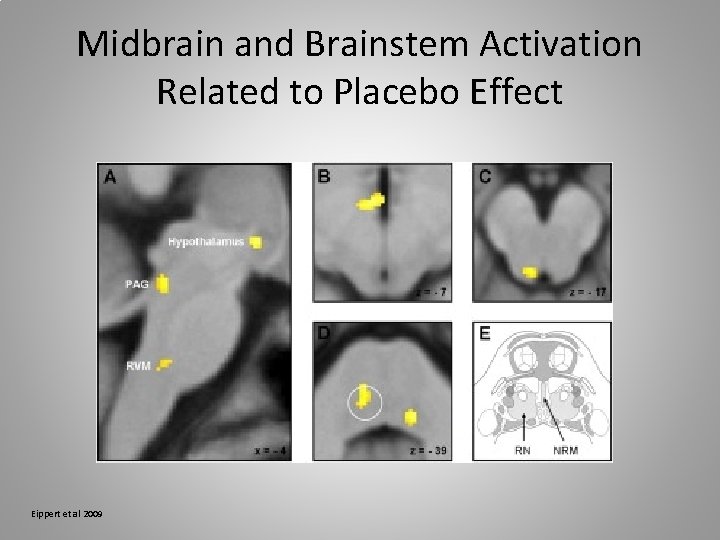 Midbrain and Brainstem Activation Related to Placebo Effect Eippert et al 2009 