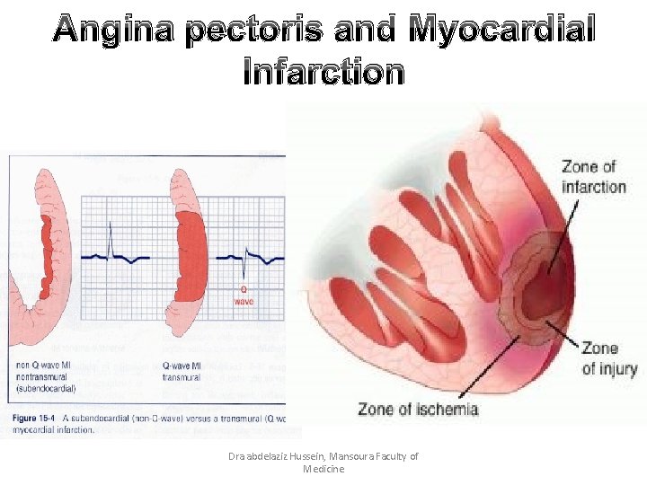 Angina pectoris and Myocardial Infarction Dra abdelaziz Hussein, Mansoura Faculty of Medicine 