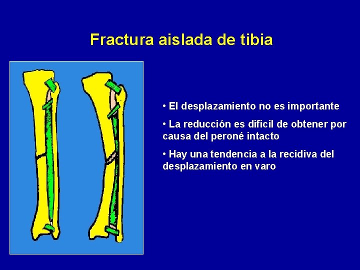 Fractura aislada de tibia • El desplazamiento no es importante • La reducción es