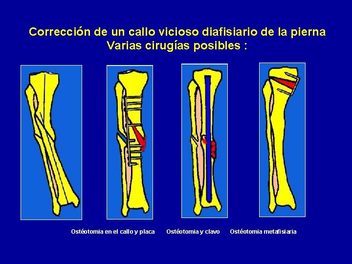 Corrección de un callo vicioso diafisiario de la pierna Varias cirugías posibles : Ostéotomia