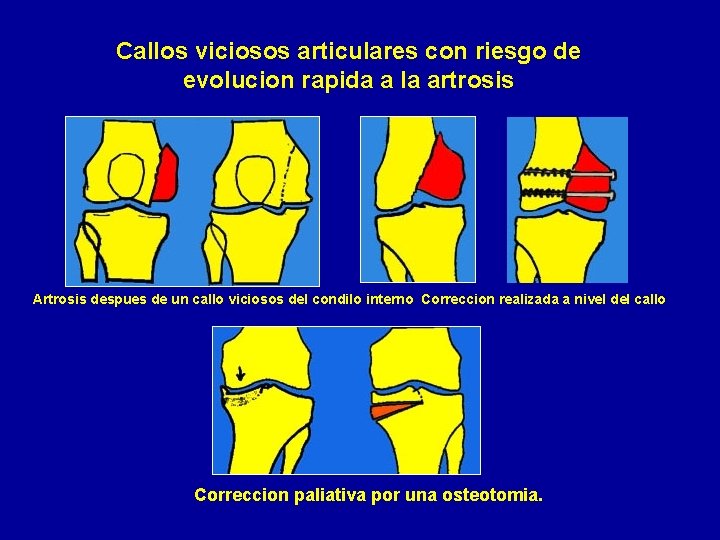 Callos viciosos articulares con riesgo de evolucion rapida a la artrosis Artrosis despues de