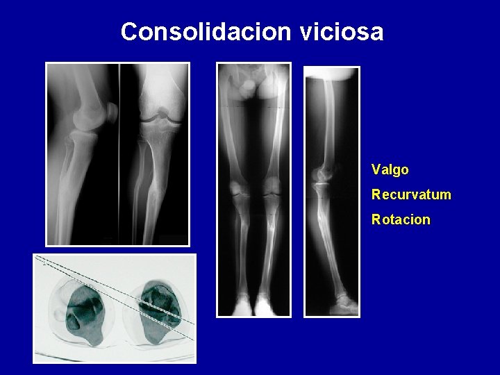 Consolidacion viciosa Valgo Recurvatum Rotacion 