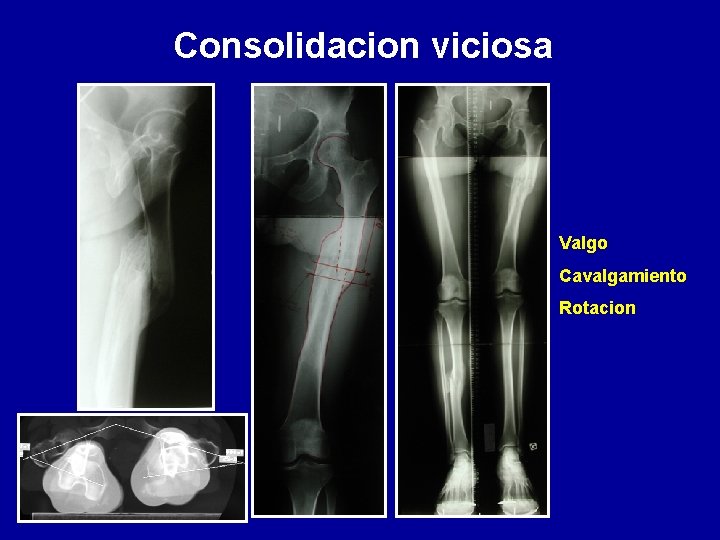 Consolidacion viciosa Valgo Cavalgamiento Rotacion 