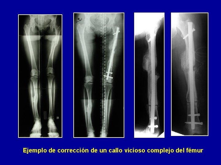 Ejemplo de corrección de un callo vicioso complejo del fémur 