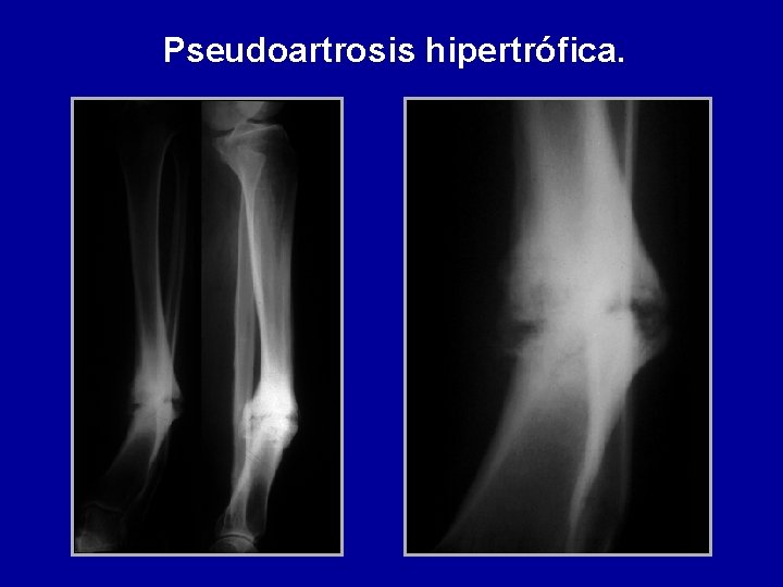 Pseudoartrosis hipertrófica. 