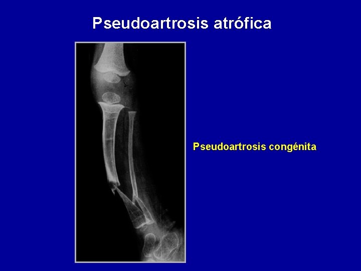 Pseudoartrosis atrófica Pseudoartrosis congénita 