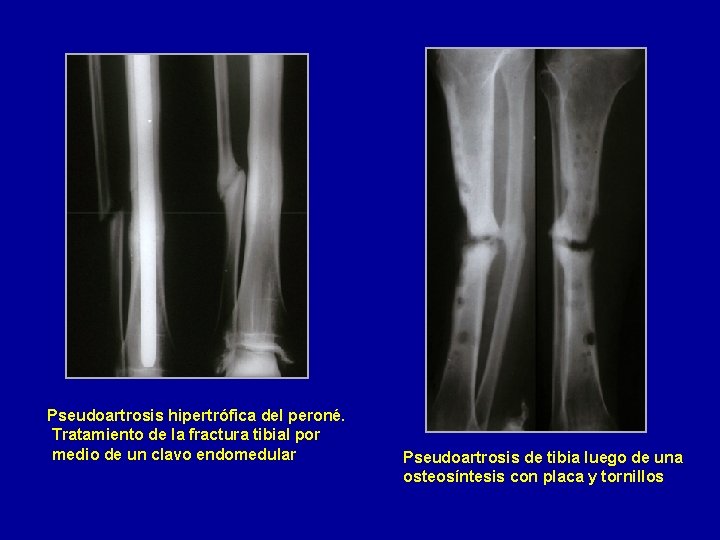 Pseudoartrosis hipertrófica del peroné. Tratamiento de la fractura tibial por medio de un clavo