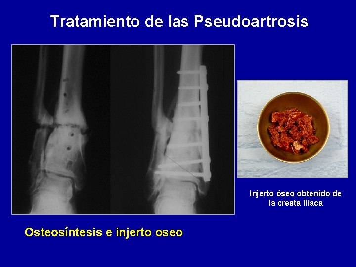 Tratamiento de las Pseudoartrosis Injerto óseo obtenido de la cresta iliaca Osteosíntesis e injerto