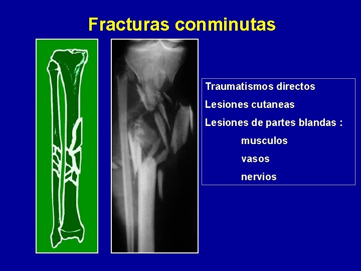 Fracturas conminutas Traumatismos directos Lesiones cutaneas Lesiones de partes blandas : musculos vasos nervios