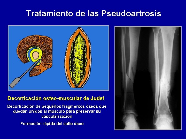 Tratamiento de las Pseudoartrosis Decorticación osteo-muscular de Judet Decorticación de pequéños fragmentos óseos quedan