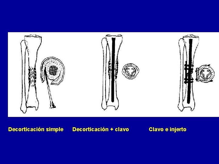 Decorticación simple Decorticación + clavo Clavo e injerto 