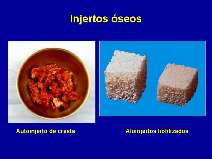 Injertos óseos Autoinjerto de cresta Aloinjertos liofilizados 